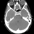Normal CT of the neck (Radiopaedia 14575-14500 Axial C+ 6).jpg