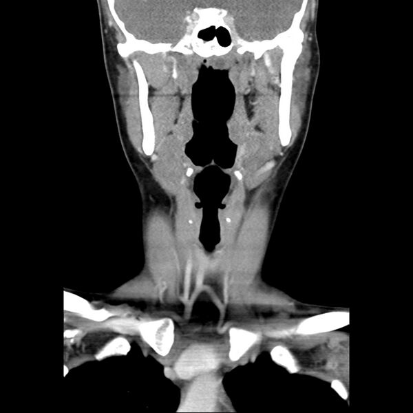 File:Normal CT of the neck (Radiopaedia 14575-14500 Coronal C+ 24).jpg