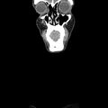 Normal CT of the neck (Radiopaedia 14575-14500 Coronal C+ 5).jpg
