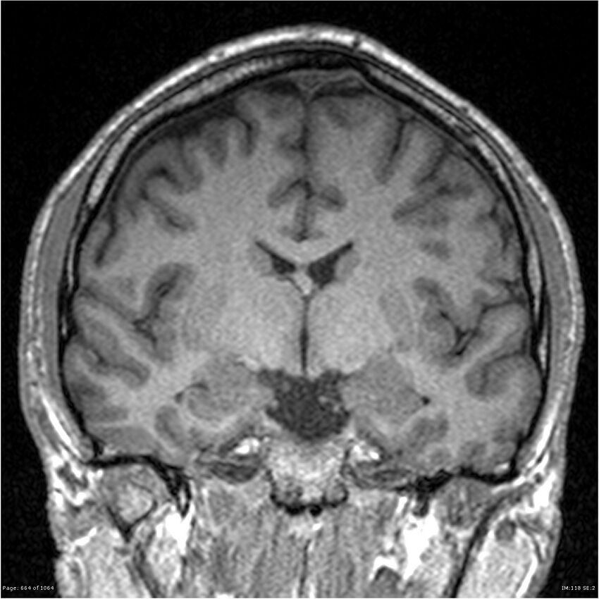 Normal brain MRI (non-focal epilepsy protocol) (Radiopaedia 38571-40700 Coronal T1 58).jpg