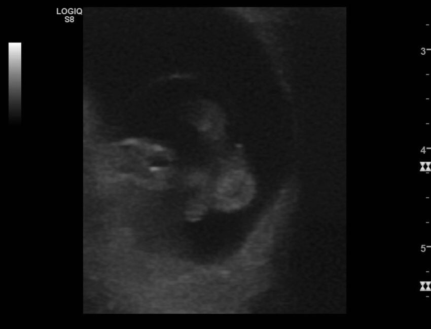 Normal early pregnancy - 8w0d (Radiopaedia 44715-48492 Longitudinal 48).jpg