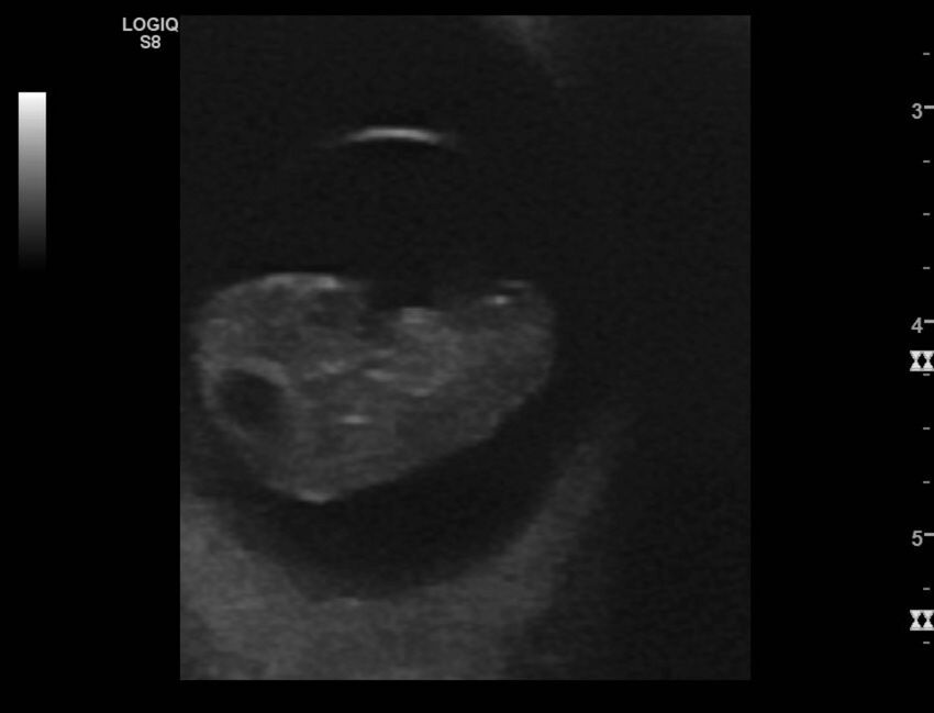 Normal early pregnancy - 8w0d (Radiopaedia 44715-48492 Longitudinal 89).jpg