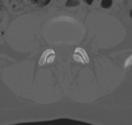 Normal lumbar spine CT (Radiopaedia 46533-50986 Axial bone window 54).png