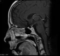 Normal pituitary (Radiopaedia 7800-8624 Sagittal T1 C+ 1).jpg