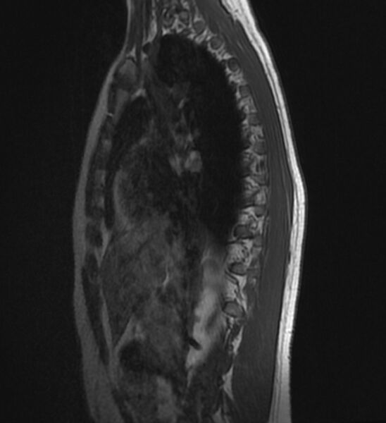 File:Normal thoracic spine MRI (Radiopaedia 41033-43781 Sagittal T1 2).jpg