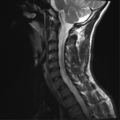 Normal trauma cervical spine (Radiopaedia 41017-43762 Sagittal T2 10).png