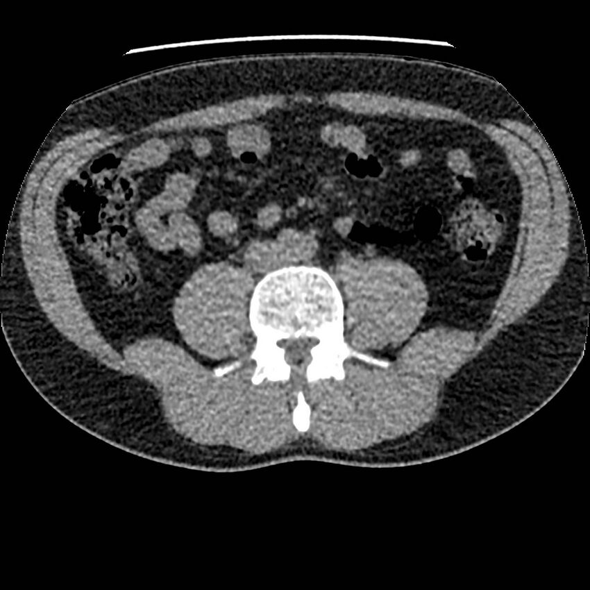 Obstructing ureteric calculus and ureteric anatomy (Radiopaedia 62730-71042 Axial non-contrast 80).jpg