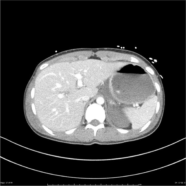 File:Traumatic renal artery dissection and pancreatic transection (Radiopaedia 37061-38739 Axial 269).jpg
