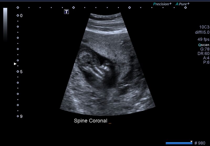 File:1st trimester nuchal-morphology ultrasound (Radiopaedia 44706-48477 General anatomy and NT 38).jpg
