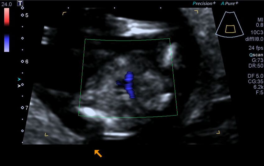 1st trimester nuchal-morphology ultrasound (Radiopaedia 44706-48477 Heart views cine with colour 182).jpg