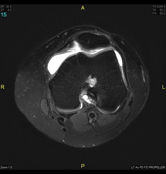 File:ACL mucoid degeration with cystic changes (Radiopaedia 48428-53341 Axial PD fat sat 12).jpg