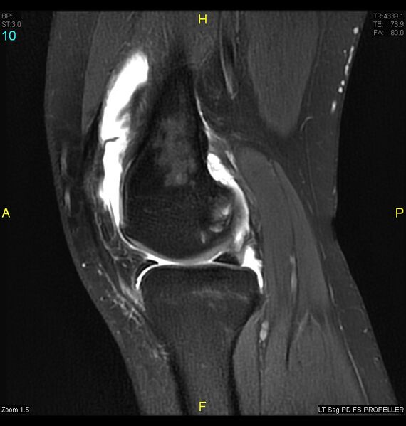 File:ACL mucoid degeration with cystic changes (Radiopaedia 48428-53341 Sagittal PD fat sat 8).jpg