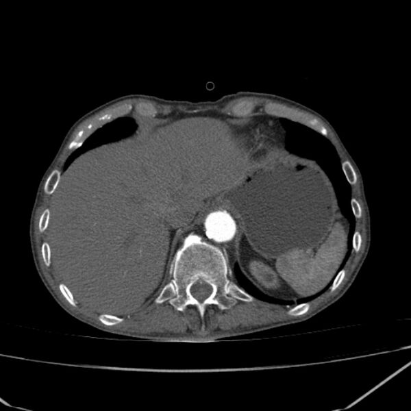 File:Abdominal aortic aneurysm (Radiopaedia 23703-23856 Axial C+ arterial phase 6).jpg
