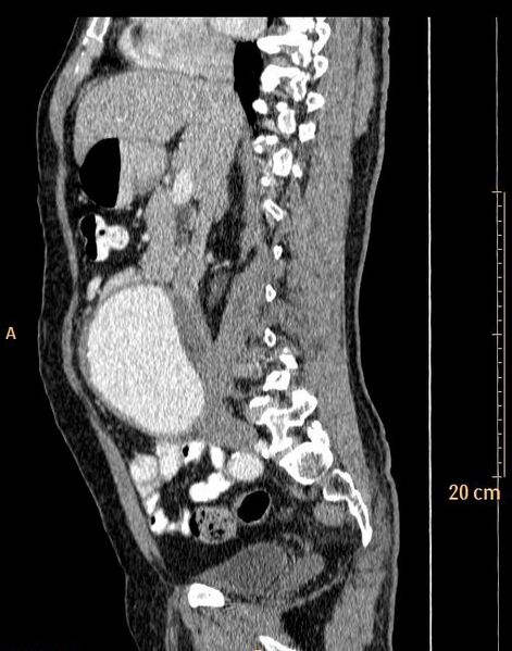 File:Abdominal aortic aneurysm (Radiopaedia 25985-26121 Sagittal C+ arterial phase 26).jpg