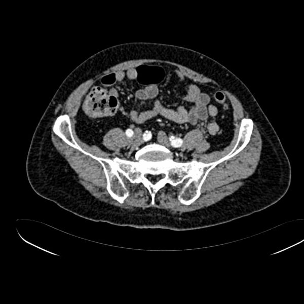 File:Abdominal aortic aneurysm (Radiopaedia 75131-86203 Axial C+ arterial phase 34).jpg