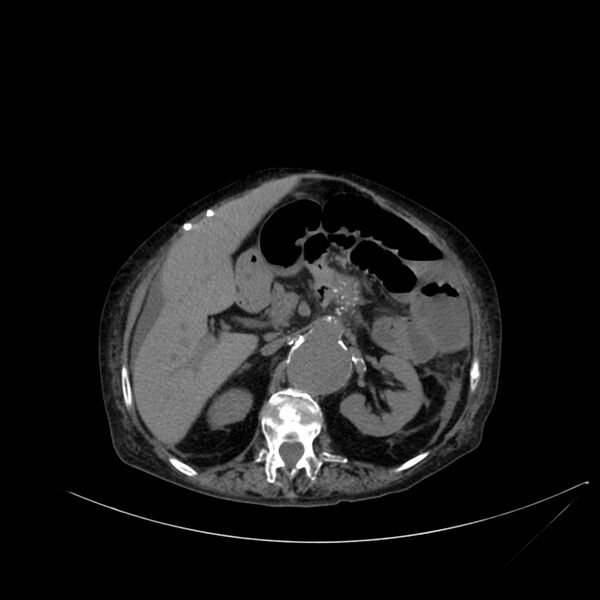 File:Abdominal aortic aneurysm - impending rupture (Radiopaedia 19233-19246 Axial non-contrast 45).jpg