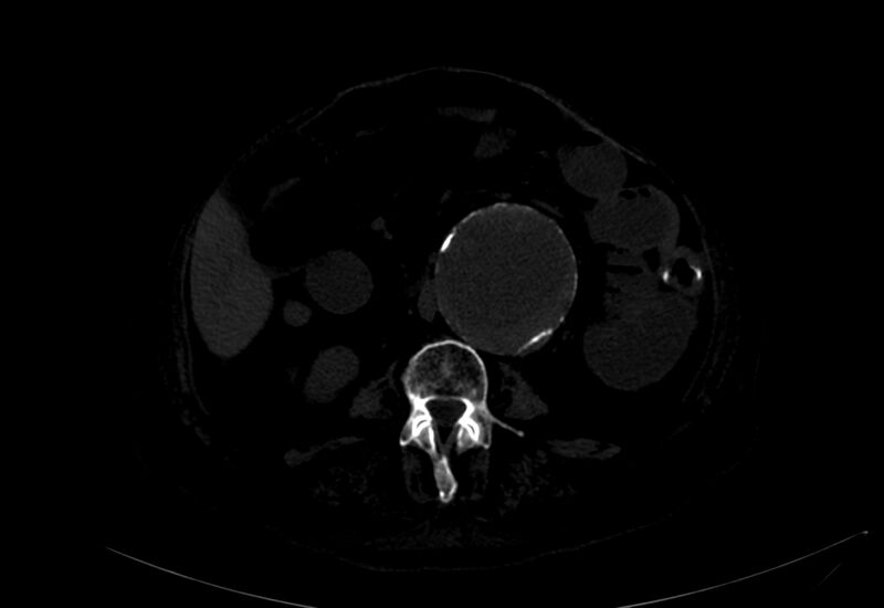 File:Abdominal aortic aneurysm - impending rupture (Radiopaedia 19233-19246 B 20).jpg