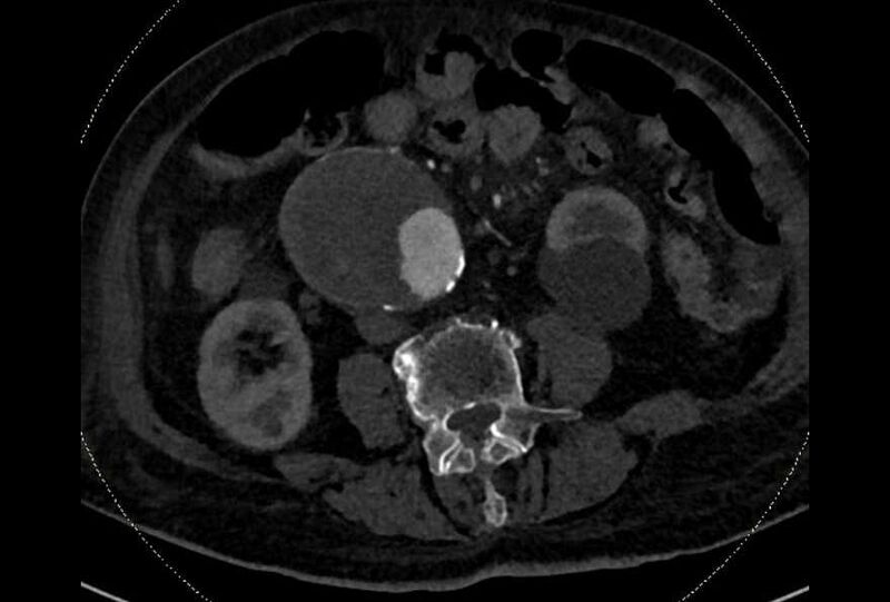 File:Abdominal aortic aneurysm with thrombus fissuration (Radiopaedia 73192-83919 Axial C+ arterial phase 115).jpg