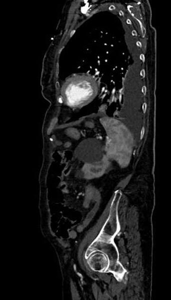 File:Abdominal aortic aneurysm with thrombus fissuration (Radiopaedia 73192-83919 Sagittal C+ arterial phase 28).jpg