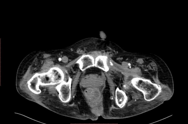 File:Abdominal aortic interposition tube graft and aneurysm thrombosis (Radiopaedia 71438-81857 Axial C+ arterial phase 248).jpg