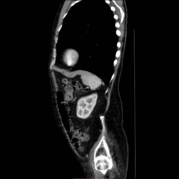 File:Abdominal aortic interposition tube graft and aneurysm thrombosis (Radiopaedia 71438-81857 Sagittal C+ arterial phase 5).jpg