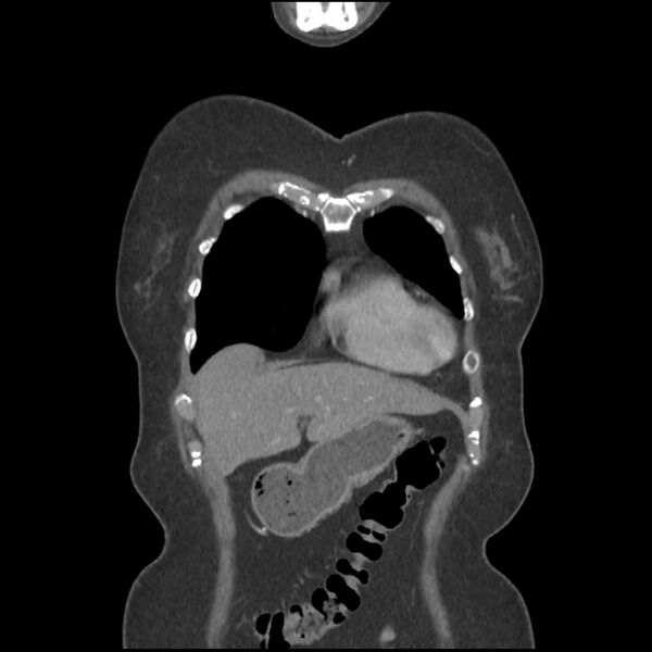 File:Aberrant right subclavian and left vertebral arteries (Radiopaedia 43467-46847 Coronal C+ portal venous phase 15).jpg