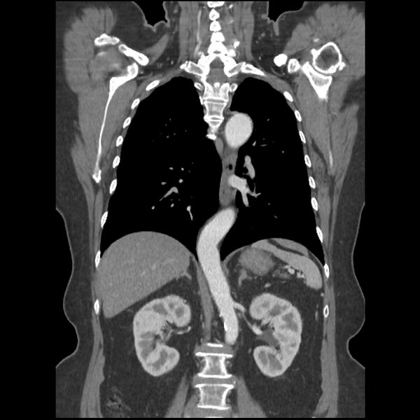 File:Aberrant right subclavian and left vertebral arteries (Radiopaedia 43467-46847 Coronal C+ portal venous phase 56).jpg