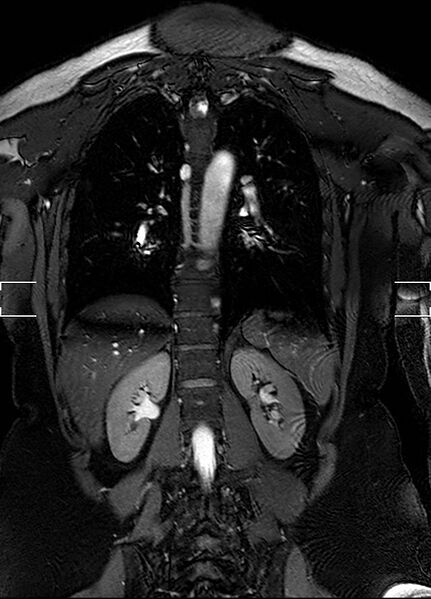 File:Aberrant right subclavian artery with background Takayasu arteritis (Radiopaedia 21423-21363 Coronal MRA 26).jpg