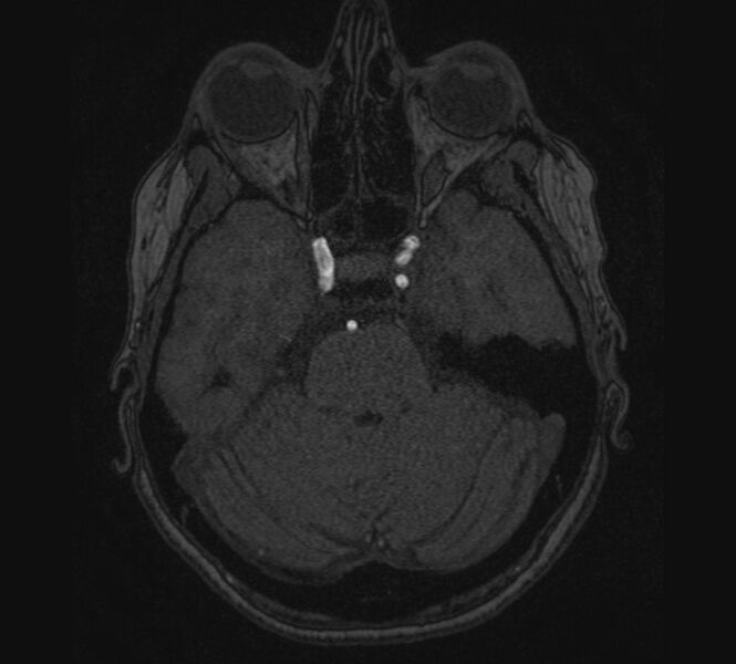 File:Accessory middle cerebral artery and ICA aneurysm (Radiopaedia 22656-22674 MRA 24).jpg