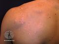 Acne affecting the back images (DermNet NZ acne-acne-back-150).jpg