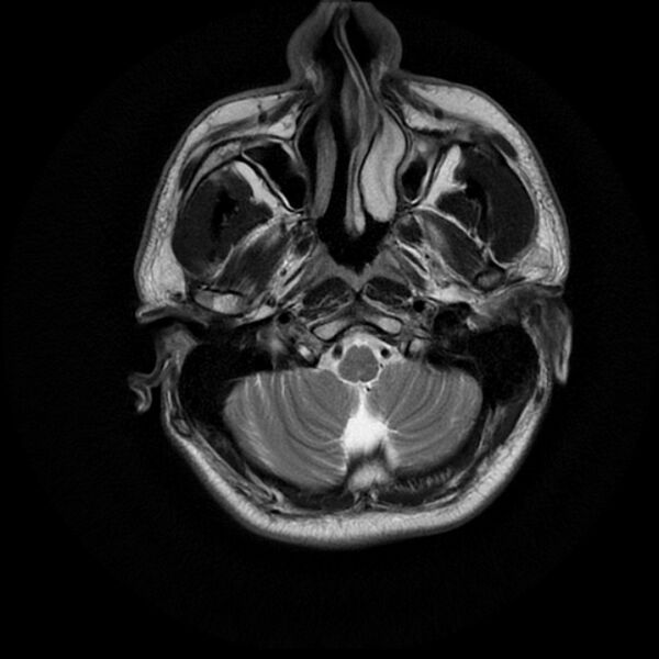 File:Acoustic schwannoma - intracanalicular (Radiopaedia 37247-39024 Axial T2 3).jpg