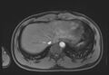 Active right ventricular cardiac sarcoidosis (Radiopaedia 55596-62100 Axial Post contrast Dixon 67).jpg