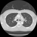 Active right ventricular cardiac sarcoidosis (Radiopaedia 55596-62101 Axial lung window 13).jpg