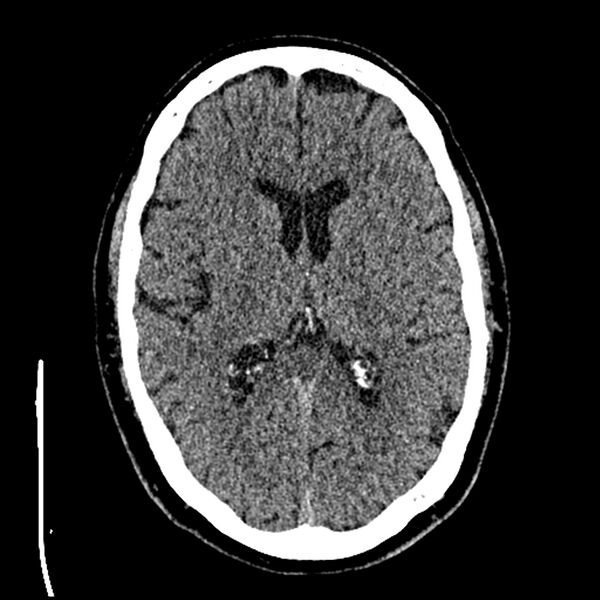 File:Acute A3 occlusion with ACA ischemic penumbra (CT perfusion) (Radiopaedia 72036-82525 Axial non-contrast thins 43).jpg