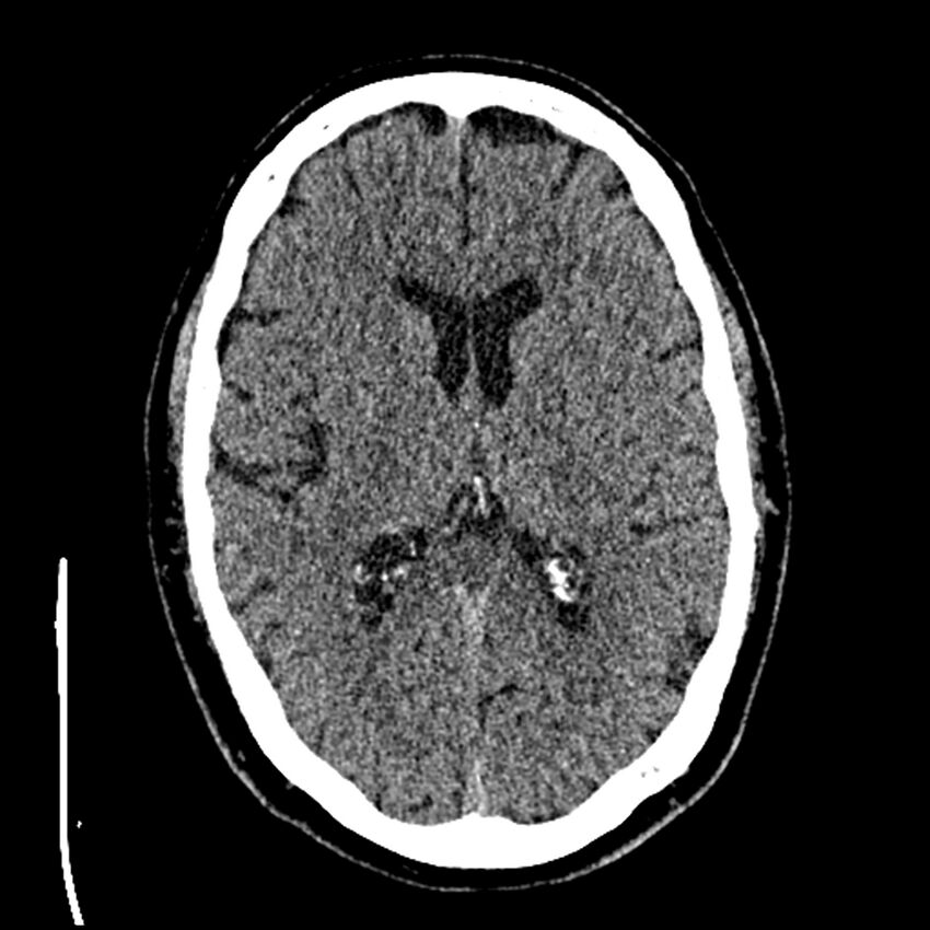Acute A3 occlusion with ACA ischemic penumbra (CT perfusion) (Radiopaedia 72036-82525 Axial non-contrast thins 43).jpg