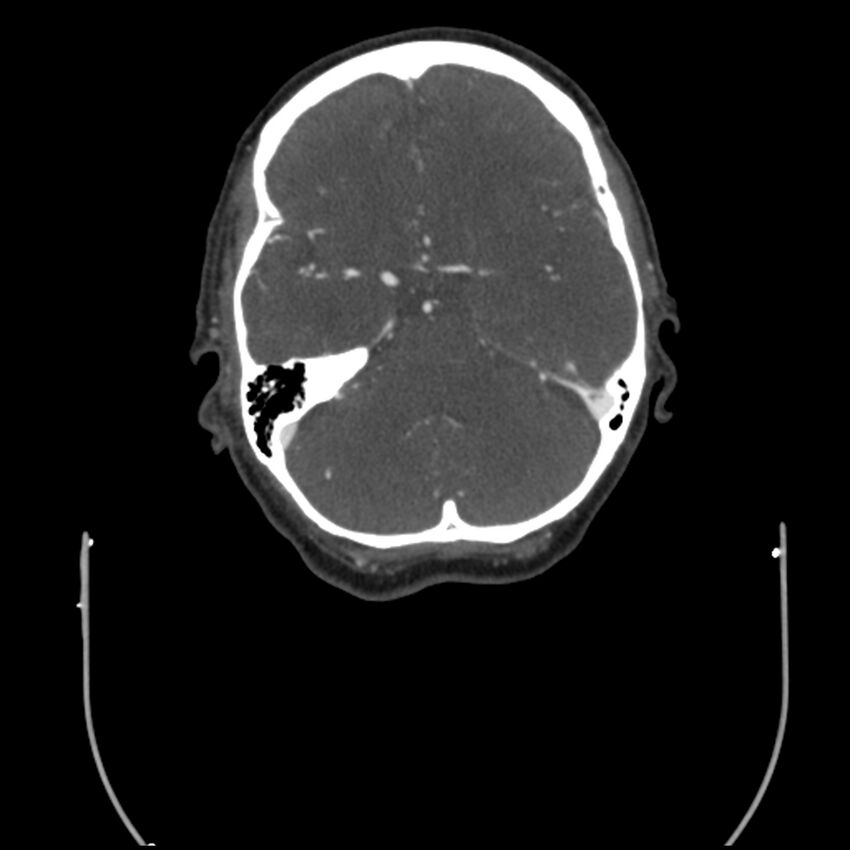 Acute M1 occlusion with ischemic penumbra (CT perfusion) (Radiopaedia 71897-82344 Axial C+ arterial phase thins 94).jpg
