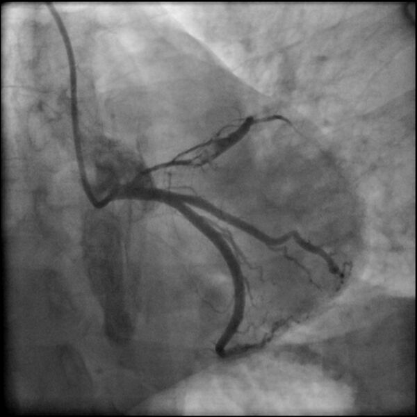 File:Acute anteroseptal myocardial infarction (Radiopaedia 68409-77946 LAO caudal (spider view) LAD and CX 29).jpg