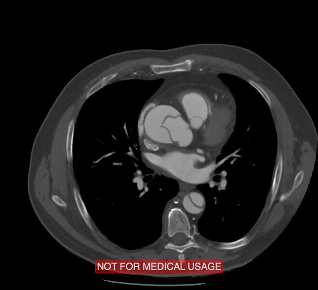 File:Acute aortic dissection - Stanford type A (Radiopaedia 40661-43285 Axial C+ arterial phase 34).jpg
