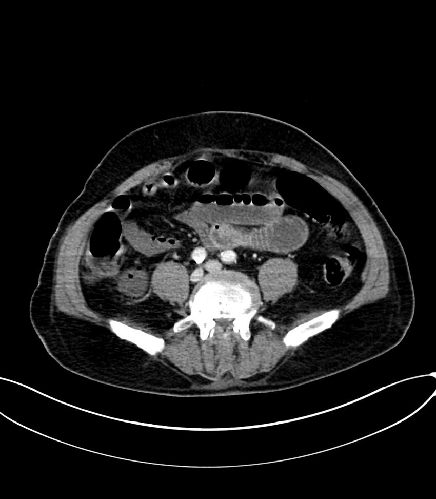 Acute arterial mesenteric ischemia (Radiopaedia 78238-90828 Axial C+ portal venous phase 92).jpg