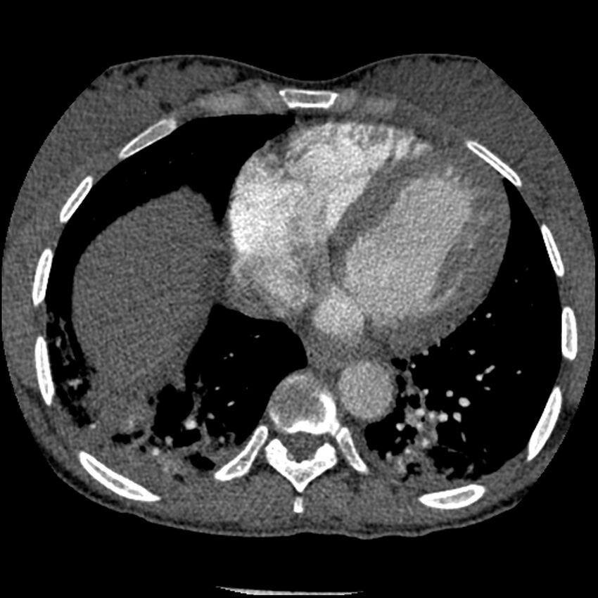 Acute chest syndrome - sickle cell disease (Radiopaedia 42375-45499 Axial C+ CTPA 137).jpg