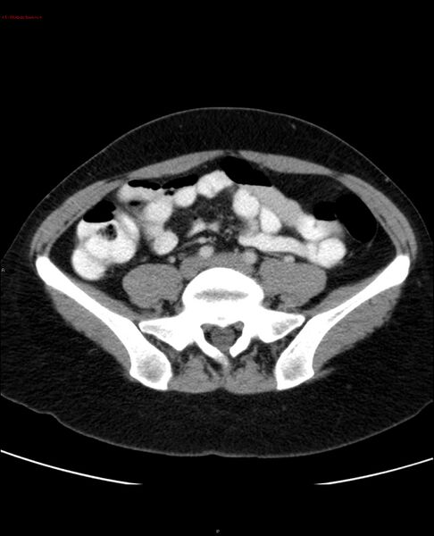 File:Acute gastritis (Radiopaedia 21043-20975 Axial C+ portal venous phase 45).jpg