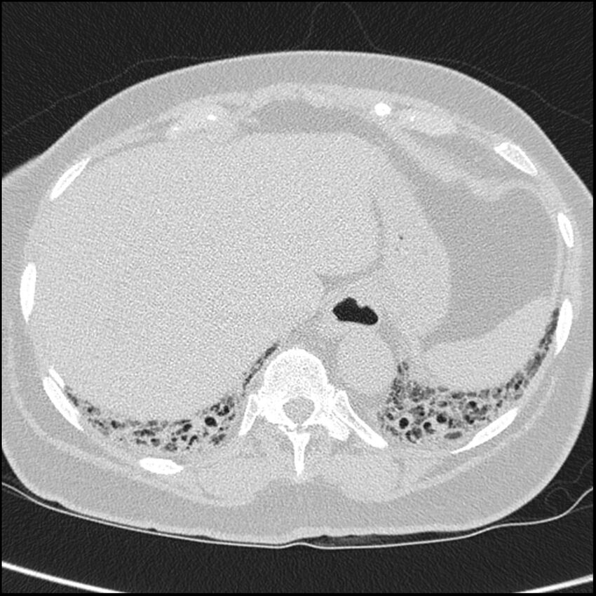 Acute interstitial pneumonitis (Radiopaedia 45404-49453 Axial lung window 68).jpg