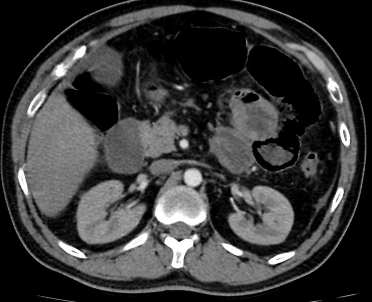 File:Acute mesenteric ischemia - superior mesenteric artery thrombosis (Radiopaedia 73947-84776 Axial C+ arterial phase 29).jpg