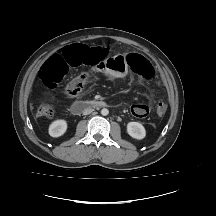 Acute mesenteric ischemia - superior mesenteric artery thrombosis (Radiopaedia 73947-84776 Axial C+ portal venous phase 60).jpg