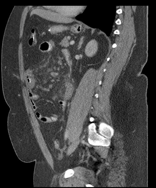 File:Acute mesenteric venous ischemia (Radiopaedia 46041-50383 Sagittal C+ portal venous phase 72).jpg