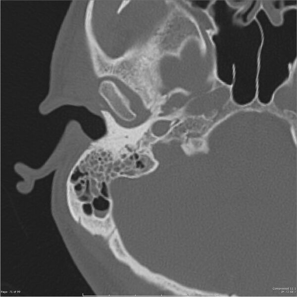 File:Acute otomastoiditis (Radiopaedia 28276-28512 Axial PTB bone window reformat 51).jpg