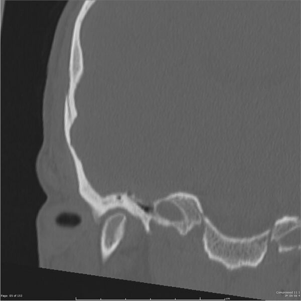 File:Acute otomastoiditis (Radiopaedia 28276-28512 Coronal PTB bone window reformat 16).jpg
