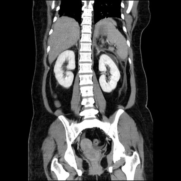 File:Acute pancreatitis (Radiopaedia 69236-79012 Coronal C+ portal venous phase 30).jpg