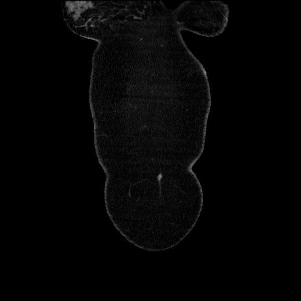 File:Acute pancreatitis (Radiopaedia 69236-79012 Coronal C+ portal venous phase 68).jpg