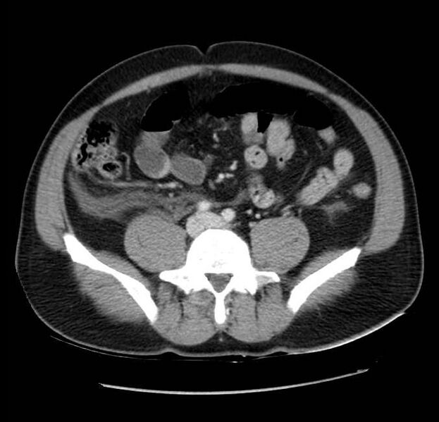 File:Acute pancreatitis - Balthazar E (Radiopaedia 23080-23110 Axial C+ portal venous phase 46).jpg